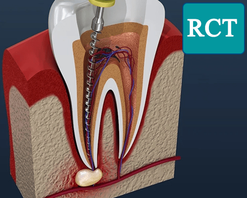 Root Canal Treatment