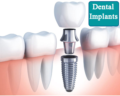 Dental Implants