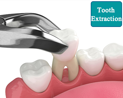 Tooth Extraction