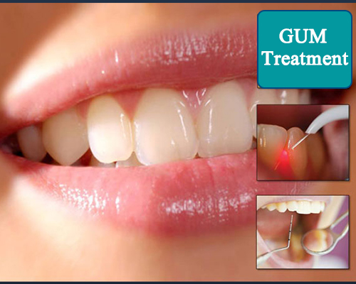 Gum Treatment