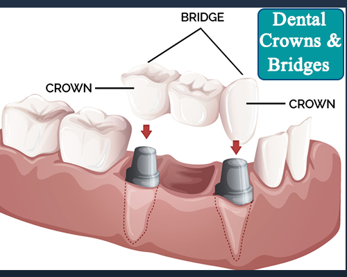 Dental Crowns & Bridges